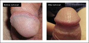 Before and After Pearly Penile Papules