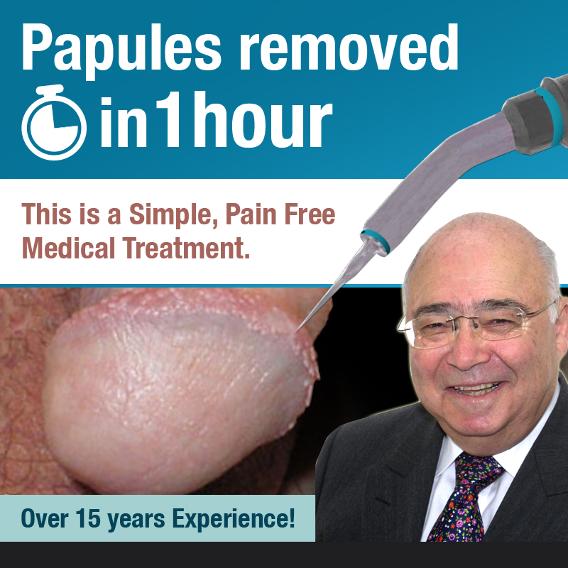 Pearly Penile Papules treatment being performed
