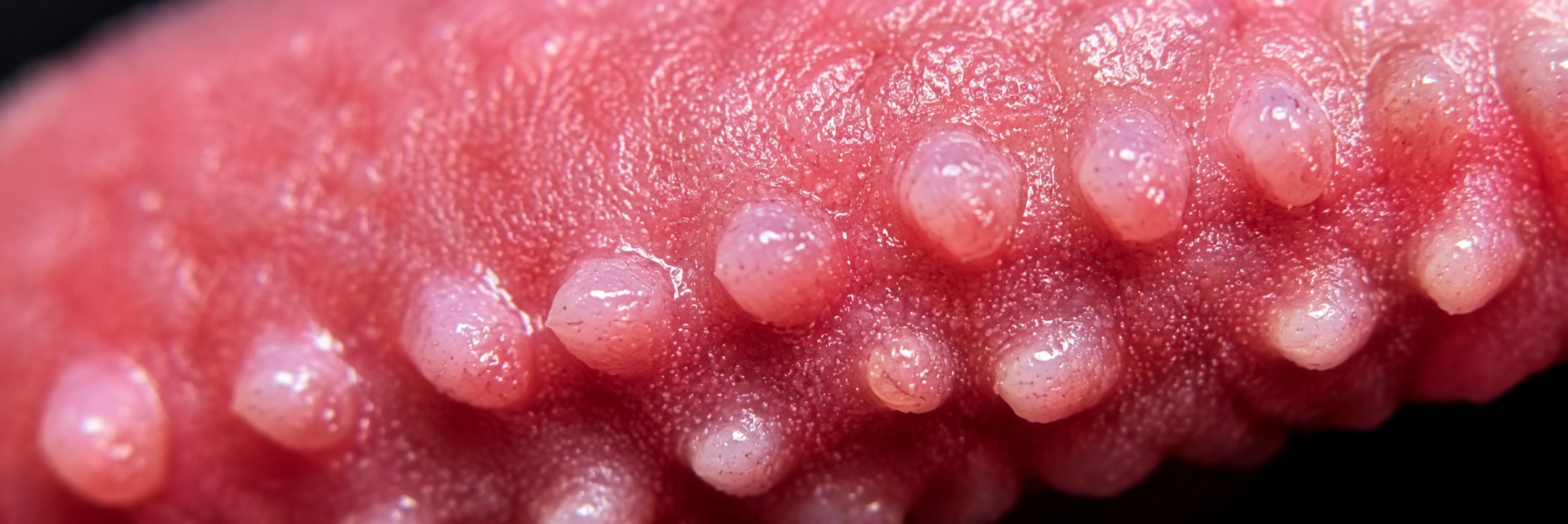 Pearly penile papules Medical Guide