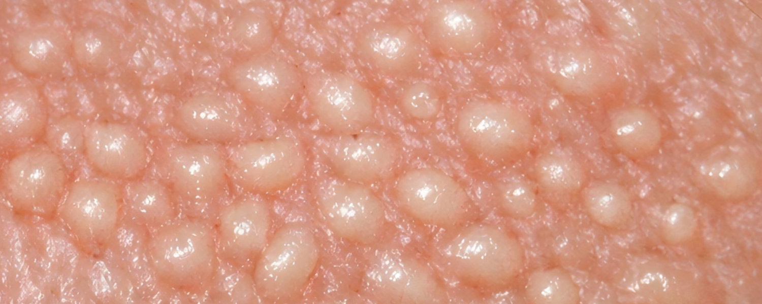 Fordyce Spots on the Penis