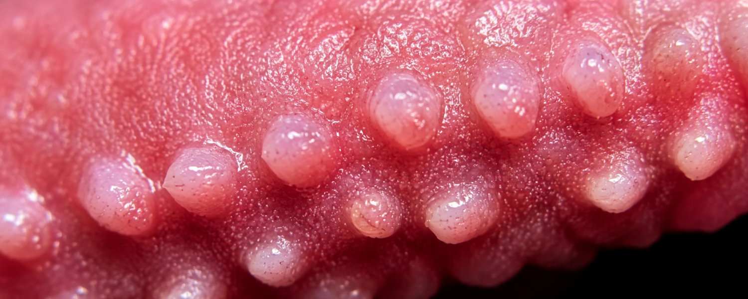 What Are Pearly Penile Papules?
